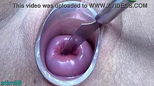 Prolapsed Cervix Lesbians Extreme Insertion